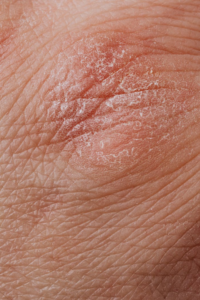 gallery-4 Detailed image highlighting dry, flaky skin texture for dermatological study.